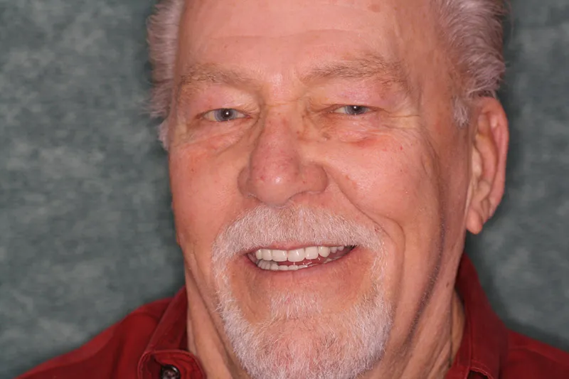 After Implant-Retained Dentures, patient of Dr Laudati, Cosmetic Dentist in St James NY
