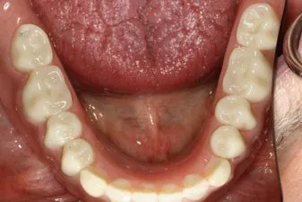 After Photo: Implant-Retained Dentures, patient of Dr Laudati, Cosmetic Dentist in St James NY