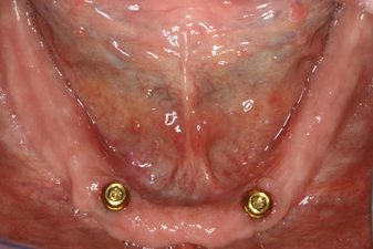 Before Photo: Implant-Retained Dentures, patient of Dr Laudati, Cosmetic Dentist in St James NY