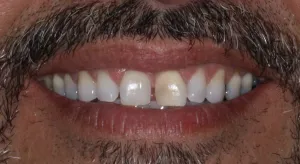 Before Photo: Porcelain Veneers, patient of Dr Laudati, Cosmetic Dentist in St James NY