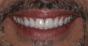 After Photo: Porcelain Veneers, patient of Dr Laudati, Cosmetic Dentist in St James NY