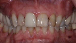 Before Photo: Porcelain Veneers, patient of  Dr Laudati, Cosmetic Dentist in St James NY
