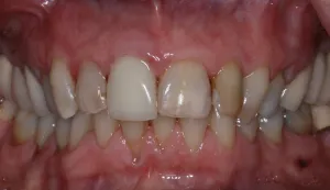 Before Photo: Porcelain Veneers, patient of Dr Laudati, Cosmetic Dentist in St James NY