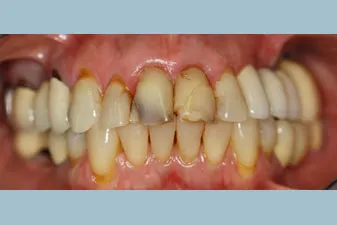 Before Photo: Dental Restoration photo, patient of Dr Laudati, Cosmetic Dentist in St James NY