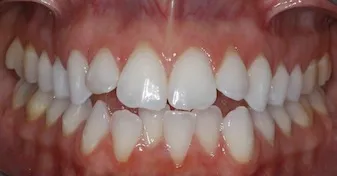 Before Photo: Invisalign treatment photo, patient of Dr Laudati, Cosmetic Dentist in St James NY