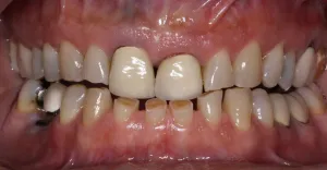 Before Photo: Patient with worn and decayed upper and lower teeth in St James NY