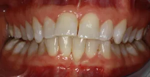 Before Photo: Invisalign treatment photo, Cosmetic Dental patient of Dr Laudati in St James NY