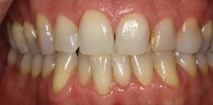 Before photo: Crowded, worn, and discolored teeth